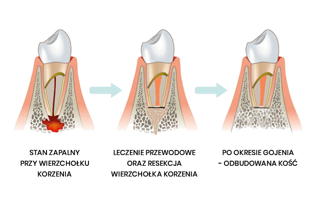 Resekcja korzeni zębów