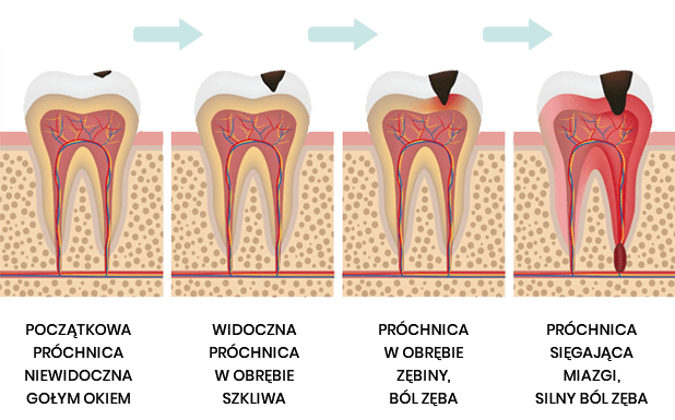 Próchnica zębowa